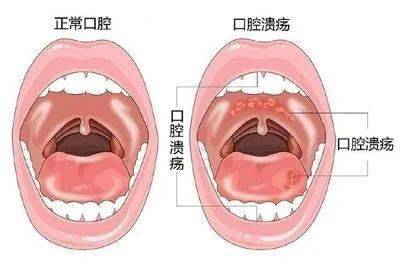 三招搞定口腔潰瘍招招管用