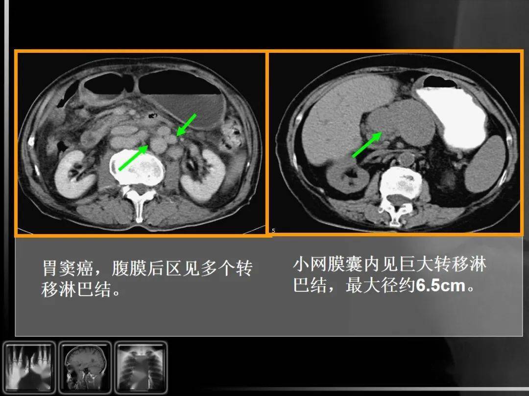 消化道疾病影像诊断与鉴别