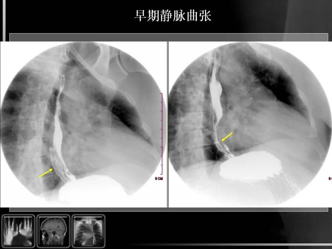 消化道疾病影像诊断与鉴别_造影