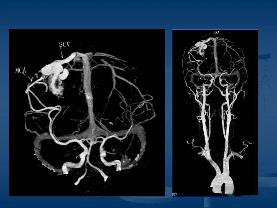 头颈部cta和dsa对血管病变的诊断