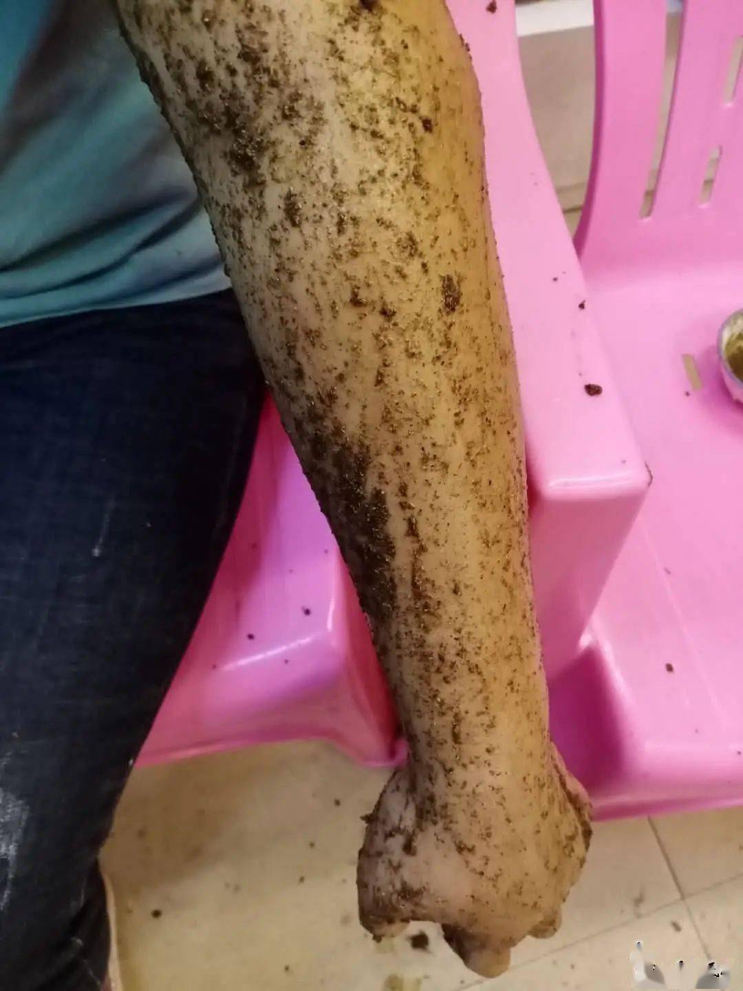 汕尾一女子被竹叶青咬伤,手肿成这样