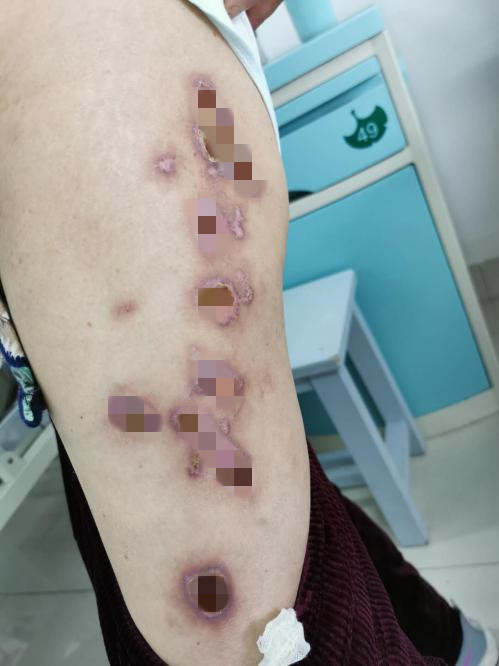 七旬阿姨膏药贴了5天竟把皮肤烧坏了