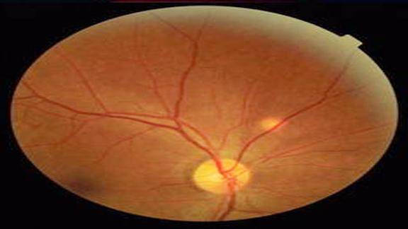 视网膜脱落的治疗方法