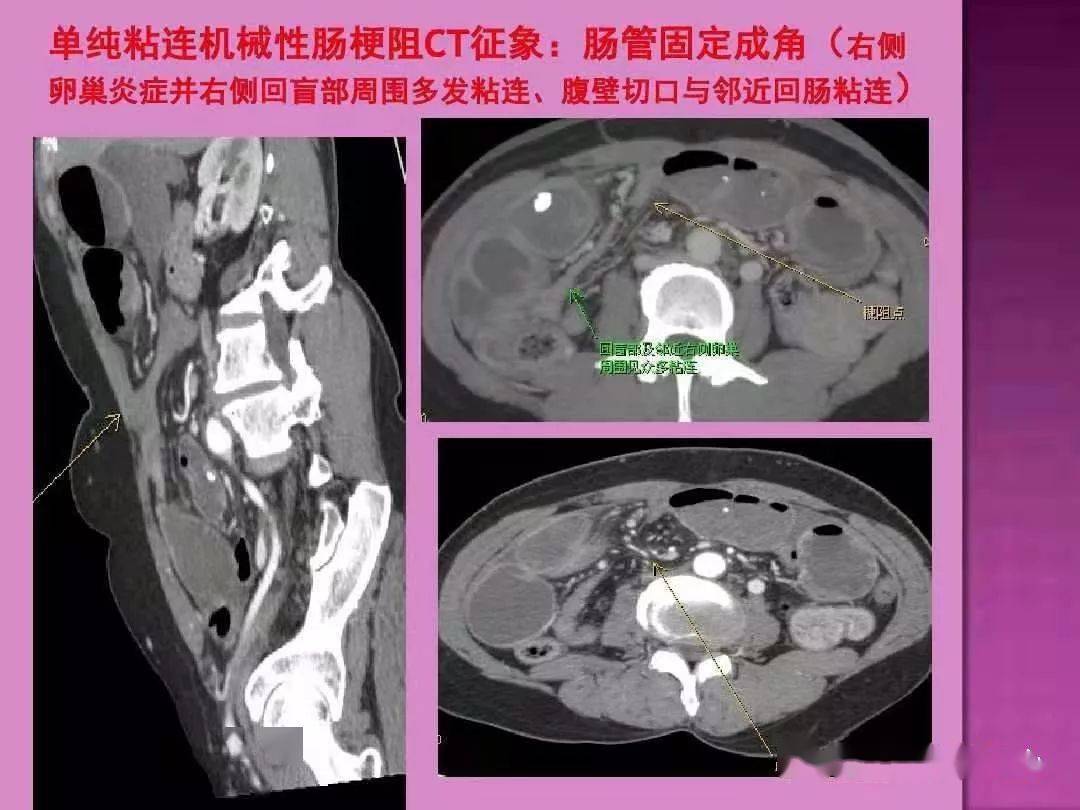 ct上如何尋找腸梗阻的梗阻點