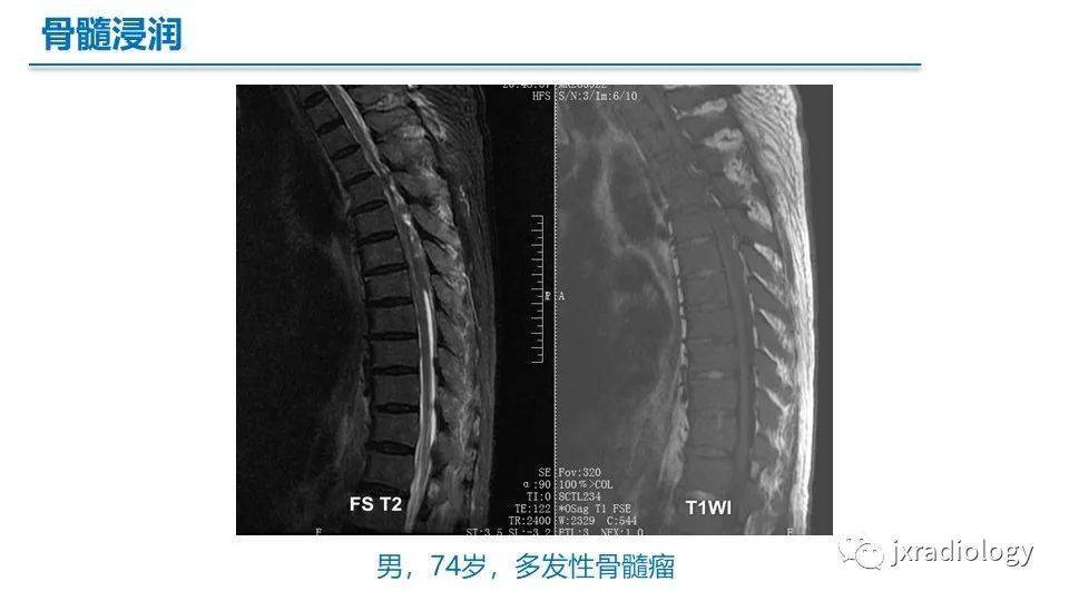 骨髓mr红骨髓黄骨髓和病变mriofbonemarrowredyellowanddiseases