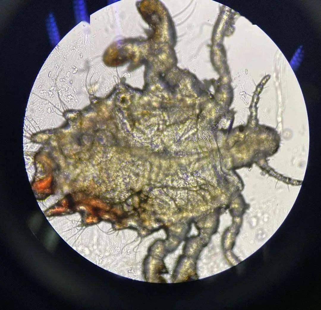 两岁男童眼睛里取出多只虱子,还在动!