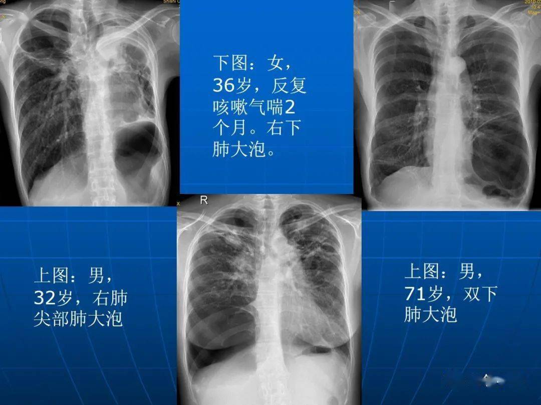 正常的肺和肺气肿图片图片