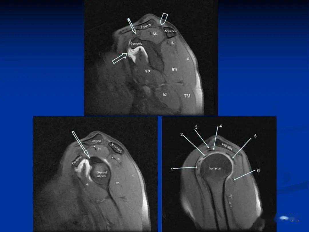 肩袖解剖及损伤的临床及mri诊断