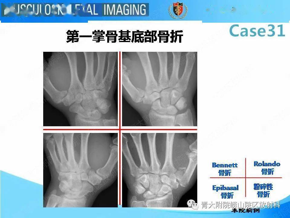 bennett骨折图片图片