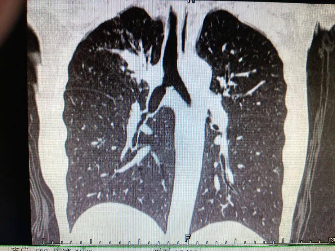 【内二科】支气管镜下取出巨大痰栓  还患者自由呼吸