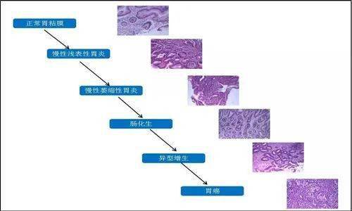 为什么慢性萎缩性胃炎治好了还会复发?你需要注意这几个问题!