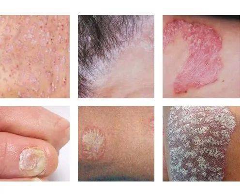 牛皮癣会传染吗