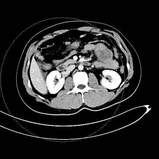 胰腺腺泡细胞癌