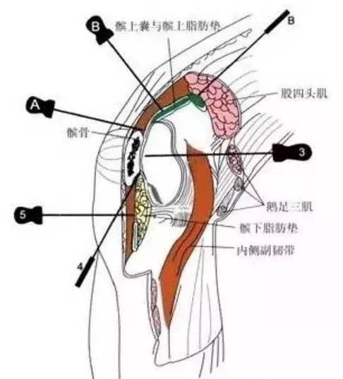 膝关节腔注射图解图片