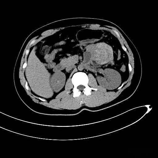 胰腺腺泡细胞癌