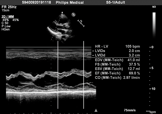 意料之外的肺动脉高压,你想到了吗?