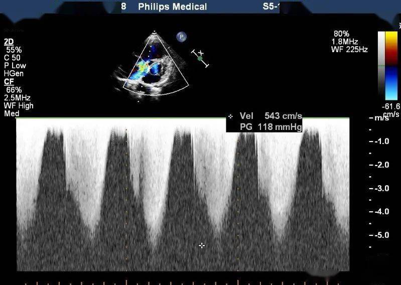 意料之外的肺动脉高压,你想到了吗?