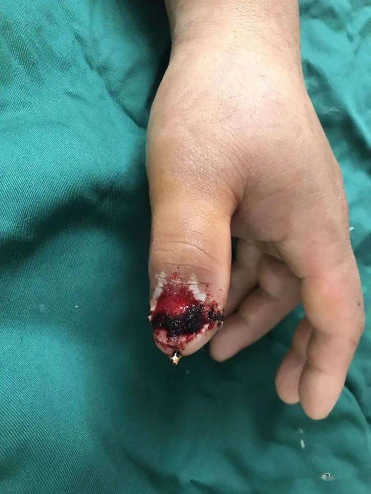 目前患指血运正常术中所见术中探查见:离断指体血管抽出并有血栓形成!