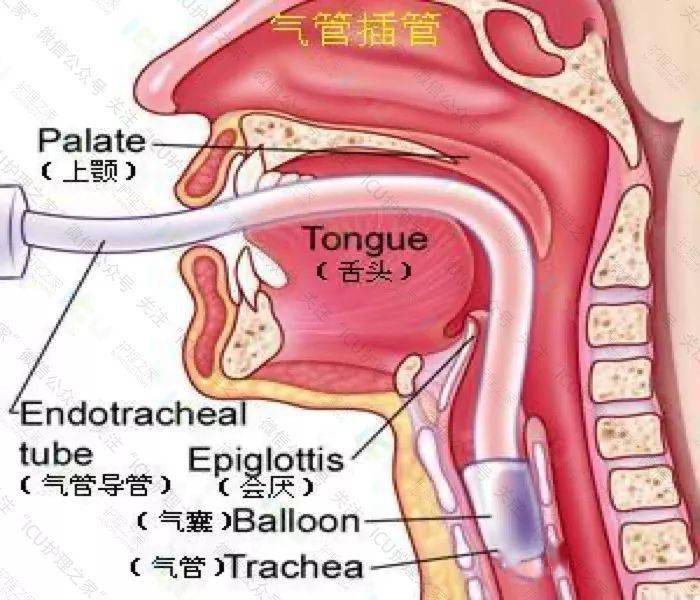 氣管切開導管的護理氣管插管導管的護理十,人工氣道導管的護理維持