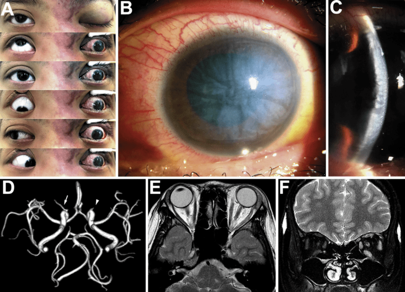 医生发现是玻尿酸逆流堵塞了眼动脉……_手机搜狐网