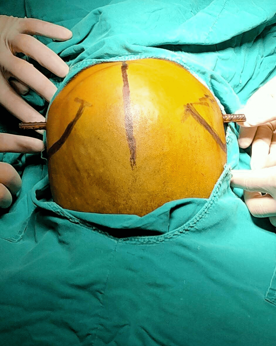 武鸣三根钢筋贯穿头部颈部胸部命悬一线附属武鸣医院多学科联合救治再