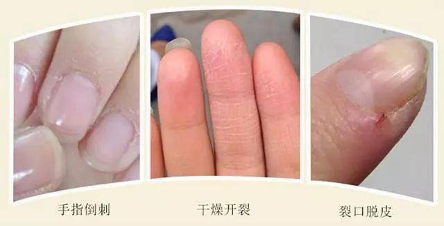 不管是指头肚干燥开裂,还是指甲缝的干裂,甚至是手指上最烦人的倒刺