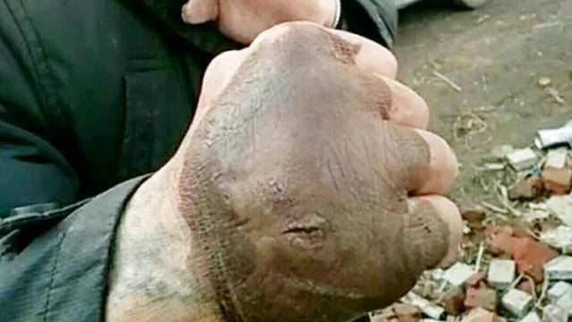 农村男子苦练铁砂掌几十年神功已练成手却成了这样
