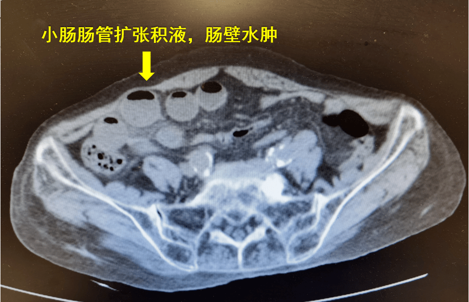 多名九〇后老人组团式手术面对高龄手术禁区怎么破