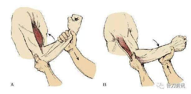 4点法针刀松解术治疗肘关节僵硬