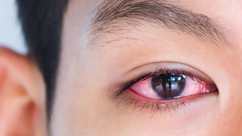 结膜炎会不会传染?这1种传染力极强!眼睛红痒怎么处理?
