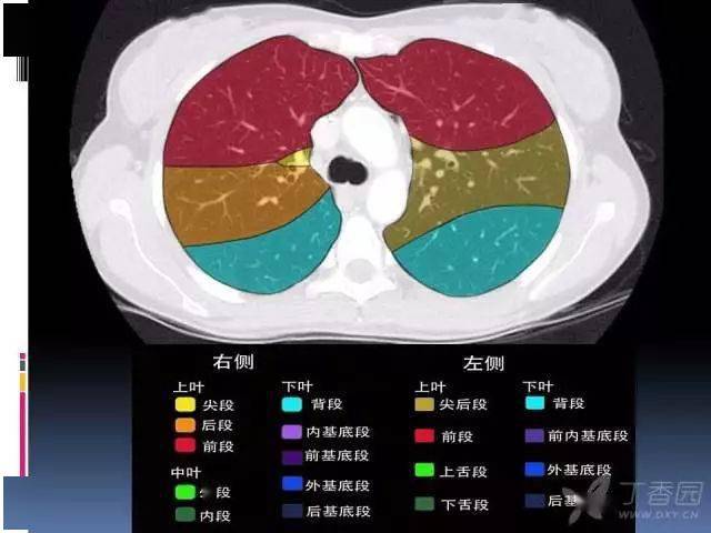 教你看肺部ct片子图解图片