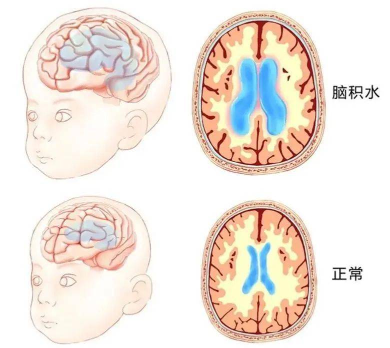 脑积水是儿童神经系统一种常见的疾病,正常情况下颅内脑脊液是不断地