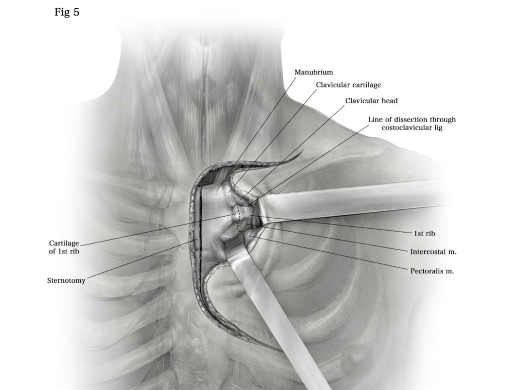 胸导管探查术图片