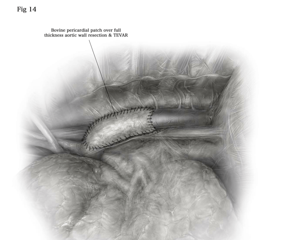 牛心包可用于固定在主动脉外膜上下全层切除.