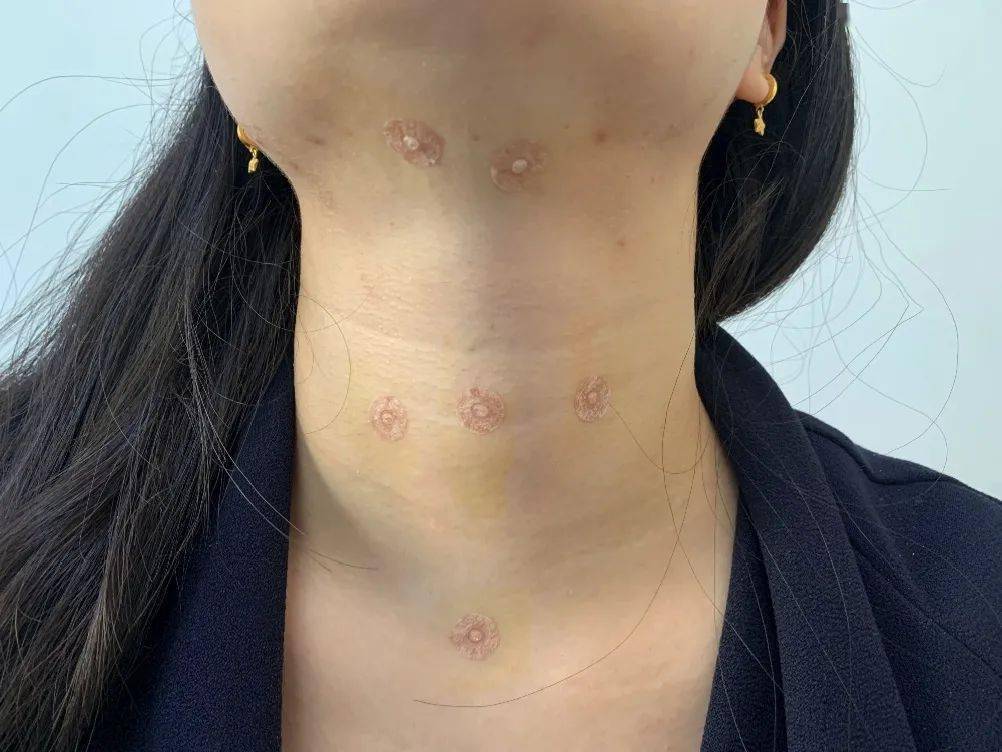 余位主流媒体朋友被吸引到院,特别对咽部雾化和揿针咽部调理大感兴趣