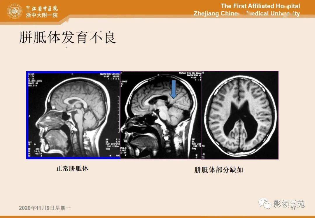 影像学表现 -- 胼胝体缺如并灰质异位,右侧侧脑室旁结节状脑灰质信号