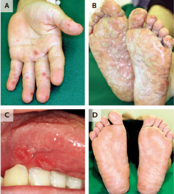 手足口病图片疱疹图片