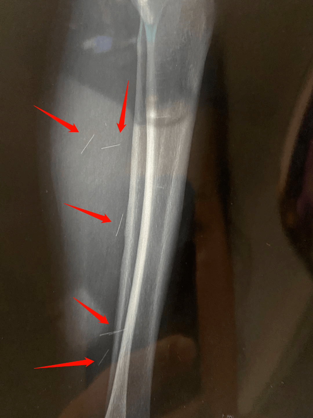 瘆人济南一市民小区诊所针灸后腿里竟发现6根断针诊所回应