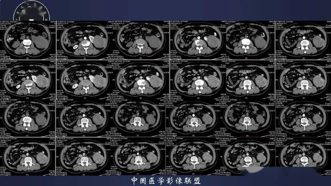 腎臟丨去分化脂肪肉瘤