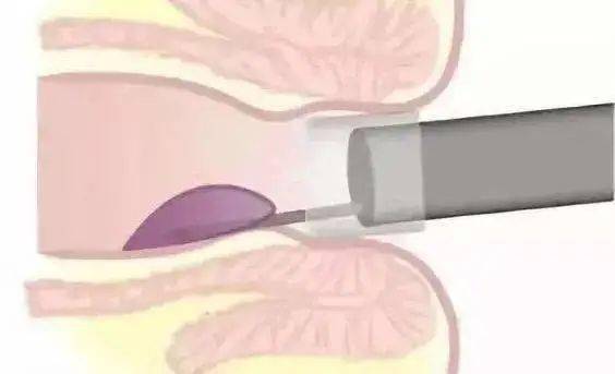 小小透明帽作用可不少