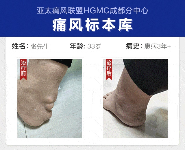 痛风患者招募补贴来了,这些检查免费,补贴3900元!内江仅200名!