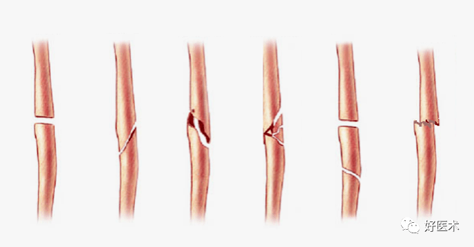 嵌插骨折图片图片