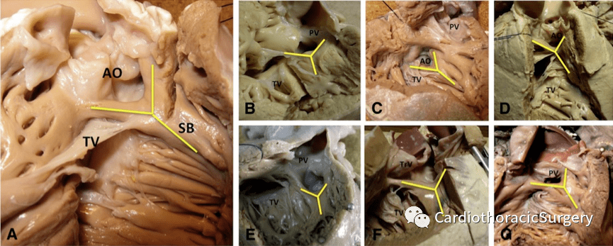jtcvs丨流出道缺陷中的室間隔缺損的解剖異同