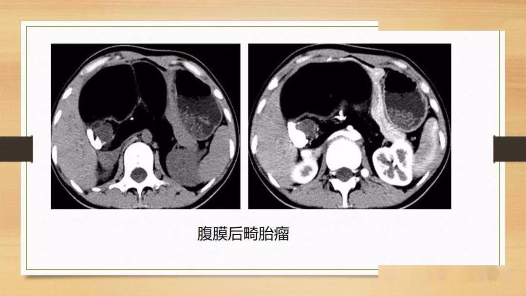 常見原發性腹膜後腫瘤影像診斷及鑑別診斷