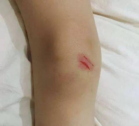 这些护理方法要get到!_伤口