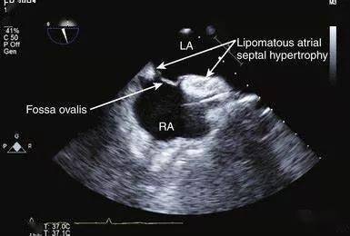 房間隔脂肪瘤樣肥厚超聲表現不合並矛盾栓塞,減壓病的卵圓孔未閉既往