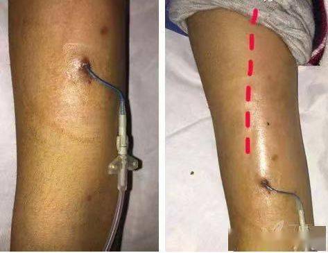 危重症护理 11-15 19:45 订阅 导语 经外周静脉置入中心静脉导管(picc