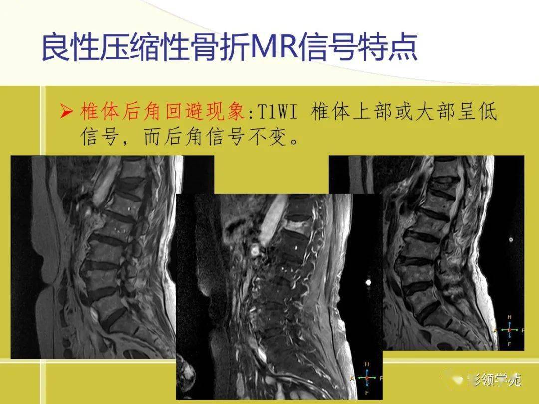 脊柱良惡性壓縮性骨折mri診斷與鑑別