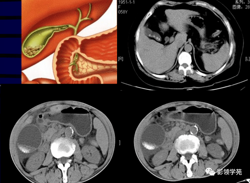 mri:t1wi和t2wi均呈低或无信号肝门区胆管癌手术后病理结果为胆总管下