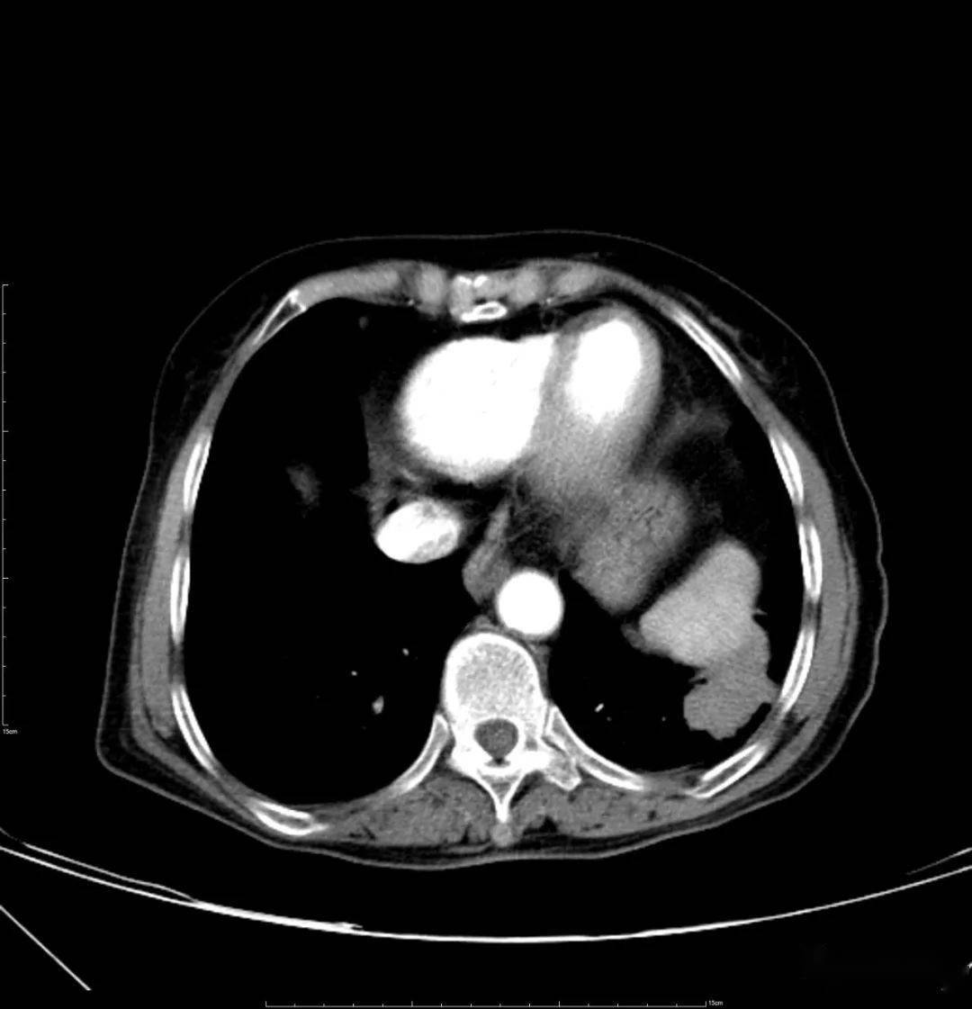 胸部ct平扫示左下肺占位——肺癌